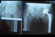 Osteoarthritis and Rheumatoid Arthritis