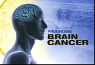 Prognosis: Brain Cancer: Canada AM